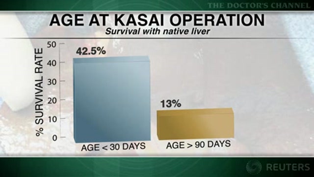 Early duct bypass operation for biliary atresia produces best outcomes Thumbnail