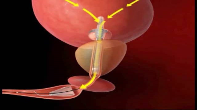 The Spanner Insertion and Removal Thumbnail