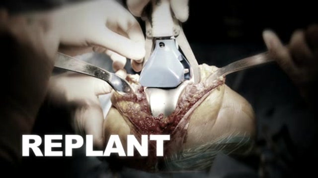 Knee cartilage cell transplantation Thumbnail