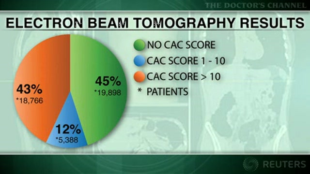 Absence of coronary calcium predicts excellent 10-year survival: study Thumbnail