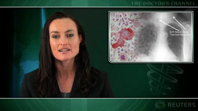 Elevated stroke risk seen in Hodgkin’s lymphoma survivors Thumbnail