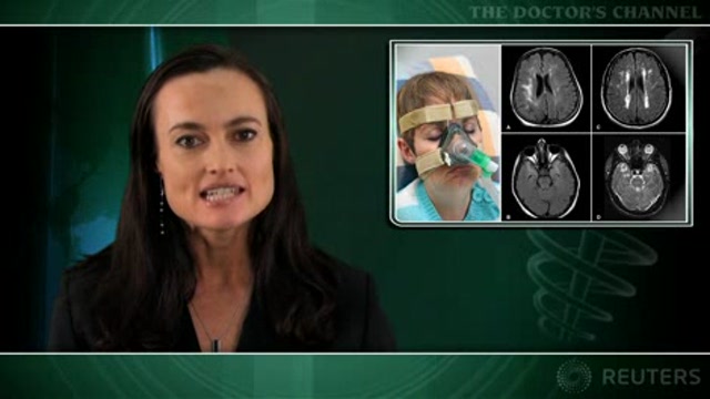CPAP reduces excess death risk in stroke patients with obstructive sleep apnea Thumbnail