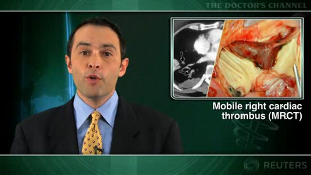 Right cardiac thrombus tied to mortality with pulmonary thromboemboli Thumbnail