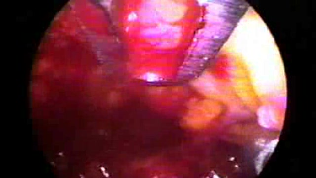 Endoscopic liposhaving – a modification of liposuction Thumbnail