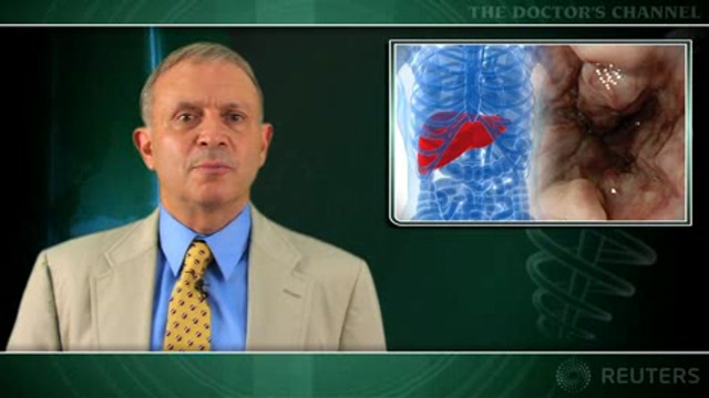 Ligation added to drug combo doesn’t cut risk of recurrent variceal bleeding Thumbnail