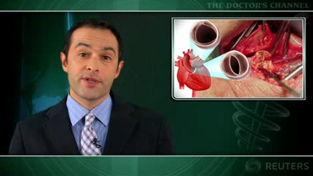 Carotid stenosis not linked to strokes after cardiac surgery Thumbnail
