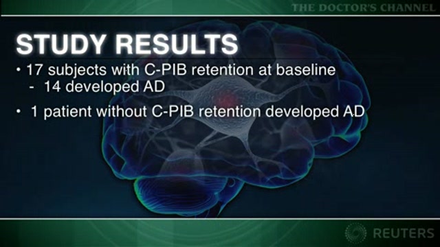 In vivo brain amyloid test predicts progression to Alzheimer disease Thumbnail