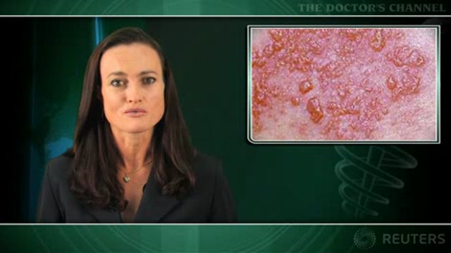 Stroke risk is dramatically higher in the year after shingles Thumbnail