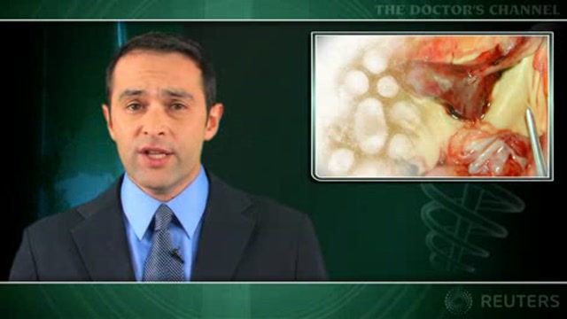 Severe H1N1 infection raises pulmonary embolism risk Thumbnail