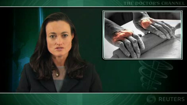 Cancer risk not affected by anti-TNF therapies for rheumatoid arthritis Thumbnail
