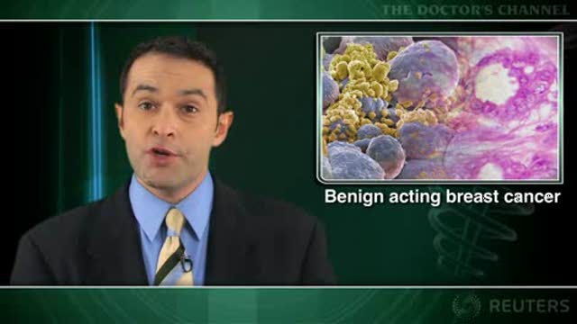 Better prognosis seen with tubular breast cancer versus grade I ductal cancer Thumbnail