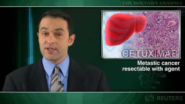 Cetuximab renders inoperable colorectal liver metastases operable: study Thumbnail