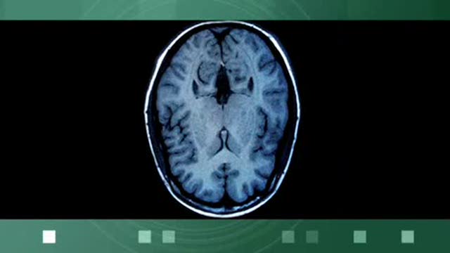 Multiple Sclerosis Smokers Thumbnail