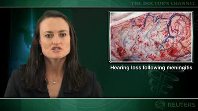 Dexamethasone, glycerol fail to prevent hearing loss in kids with meningitis Thumbnail