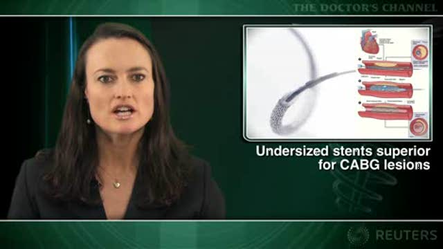 Small stents in saphenous vein graft lesions may cut risk of embolization Thumbnail