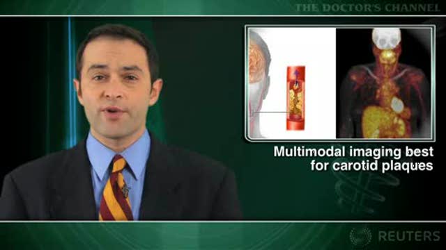 Carotid artery plaque assessment requires more than one imaging modality Thumbnail