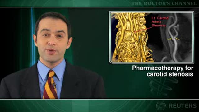 Asymptomatic carotid stenosis can usually by managed medical therapy: study Thumbnail