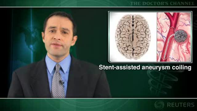 Stent-assisted coiling of intracranial aneurysms yields mixed results Thumbnail
