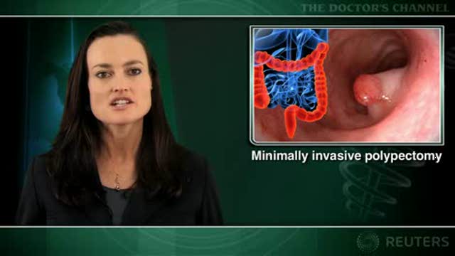 Endoscopic resection effective for large colonic polyps Thumbnail