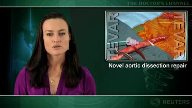 Endovascular repair improves aortic remodeling in type B aortic dissection Thumbnail