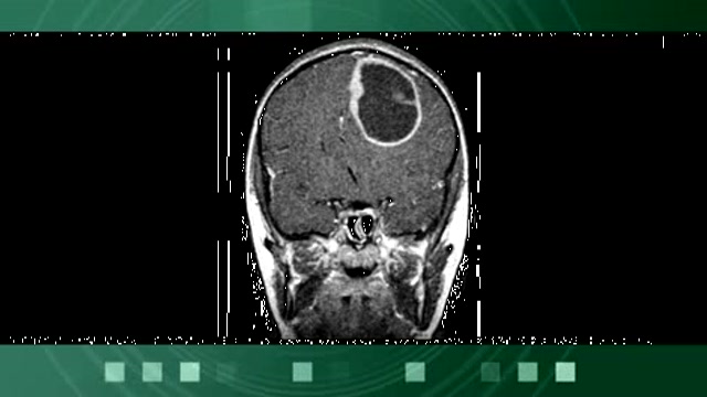 Avastin and Glioblastoma Multiforme Thumbnail