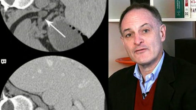 Evaluation of Adrenal Masses Thumbnail