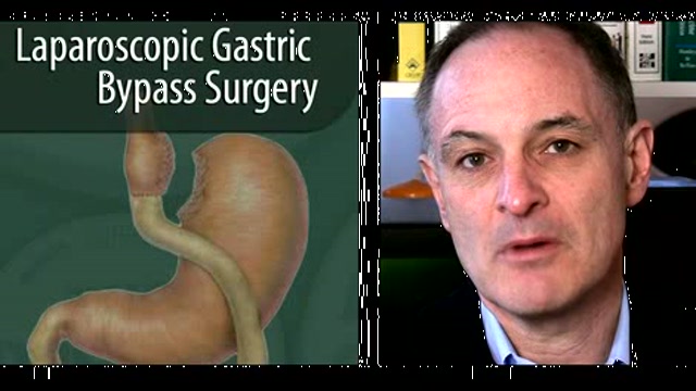 Bariatric Surgery: How surgery helps Thumbnail