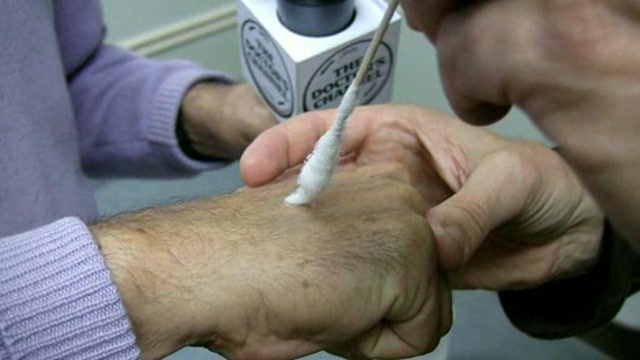 Solar Lentigenes Removal Thumbnail