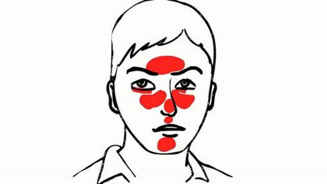 Etiology and Clinical Picture of Rosacea Thumbnail