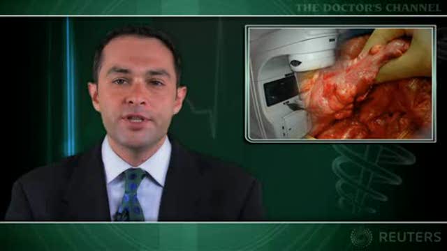 Prostate irradiation raises long-term risk of colon cancer Thumbnail