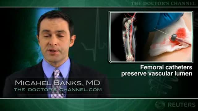 Repeat catheterizations, closure device use do not impact femoral artery size Thumbnail