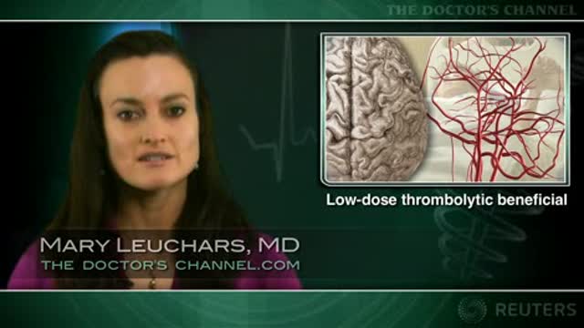 Angiography confirms efficacy of lower-dose alteplase for stroke Thumbnail