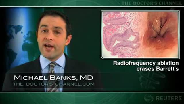 Radiofrequency ablation safely combined with surgery for Barrett’s esophagus Thumbnail