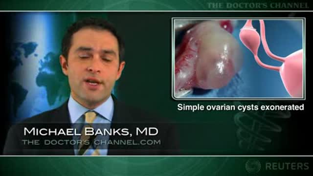 Simple ovarian cysts not linked to cancer in postmenopausal women Thumbnail