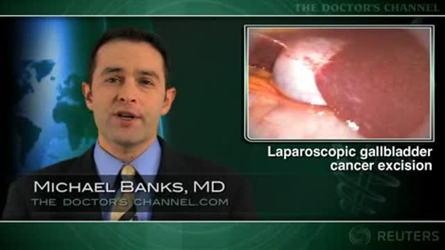 Is laparoscopy feasible for early gallbladder cancer? Thumbnail
