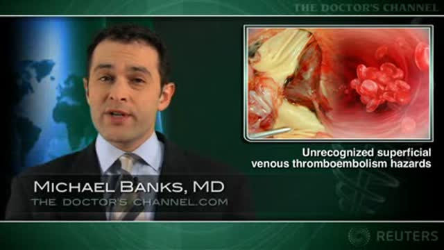 DVT, pulmonary embolism common with superficial thrombosis Thumbnail