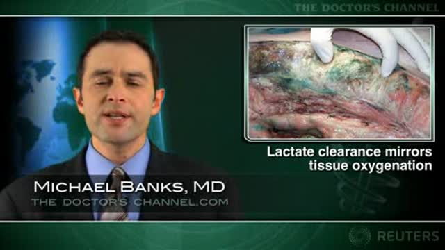 Severe sepsis therapy can be guided by lactate clearance Thumbnail