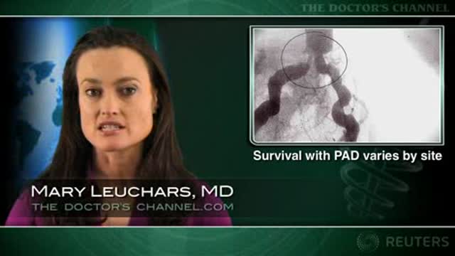 Prognosis worse with proximal peripheral arterial disease Thumbnail