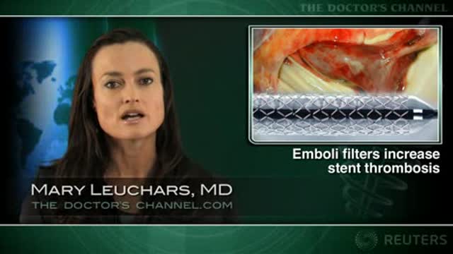 Emboli filters during PCI lead to higher risk of stent thrombosis Thumbnail