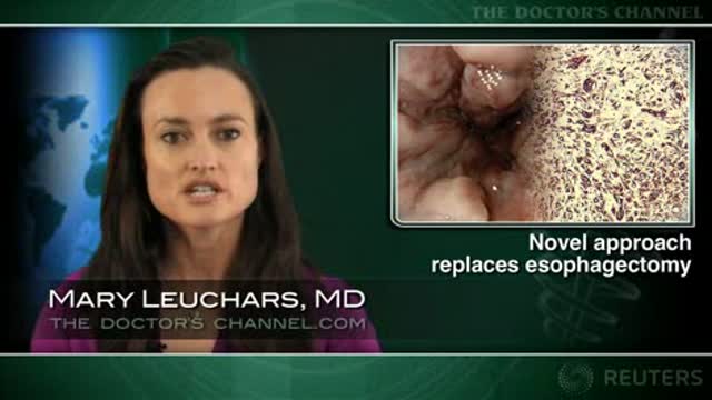 Endoscopic resection for Barrett’s esophagus usually avoids surgery Thumbnail