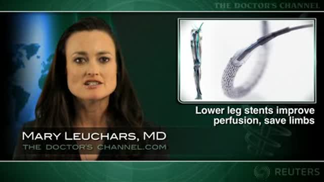 Below-the-knee drug-eluting stents prevent leg amputation Thumbnail
