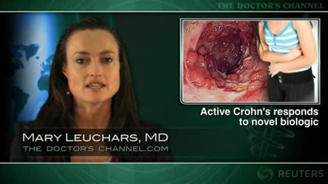 Infliximab plus azathioprine effective for stubborn Crohn’s disease Thumbnail