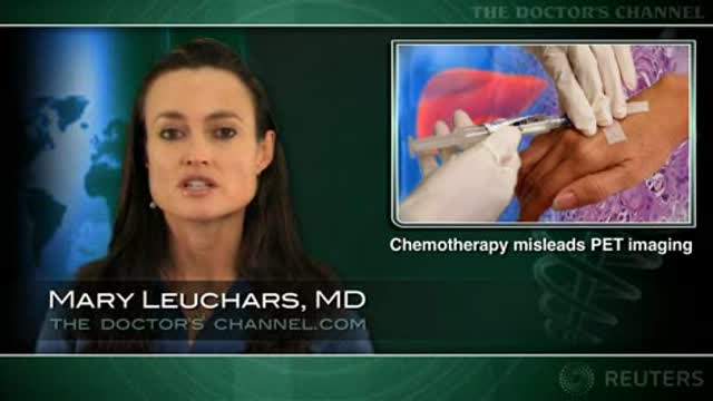 PET not useful right after chemo for colorectal liver metastases Thumbnail