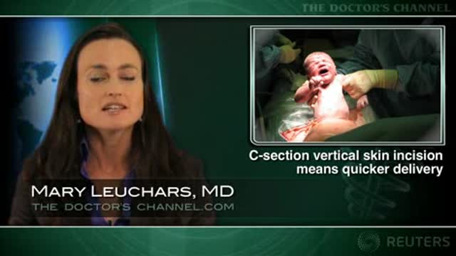Quicker c-section with vertical skin incision, but similar outcomes Thumbnail