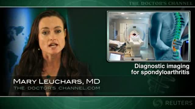 MRI aids early diagnosis of ankylosing spondylitis Thumbnail