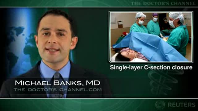 Single-layer c-section closure ups risk of uterine rupture Thumbnail