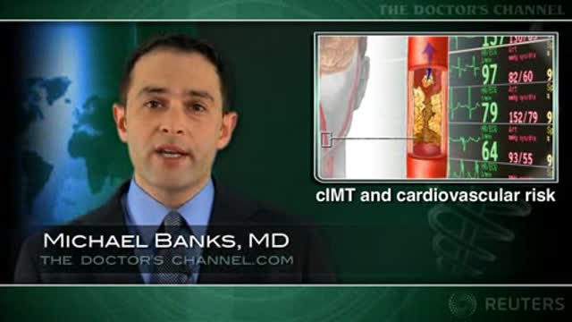 Cardiovascular risk assessment not improved with carotid measure Thumbnail