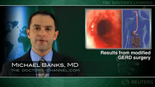 Nissen fundoplication stands the test of time compared to new approach Thumbnail