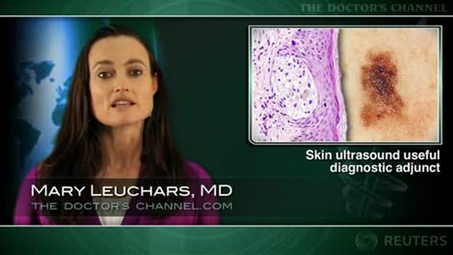 High res ultrasound helps in differential diagnosis of blue skin lesions Thumbnail
