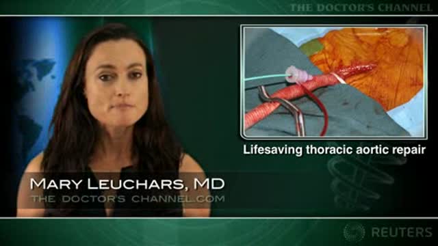 Endovascular repair of ruptured thoracic aortic aneurysm encouraging Thumbnail